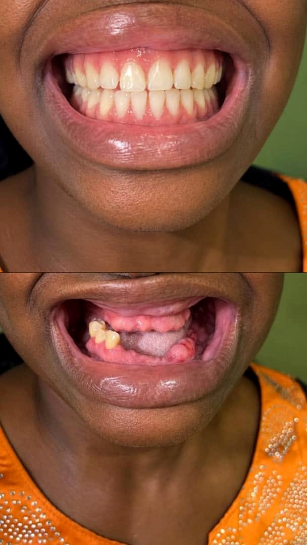 Tooth replacement case