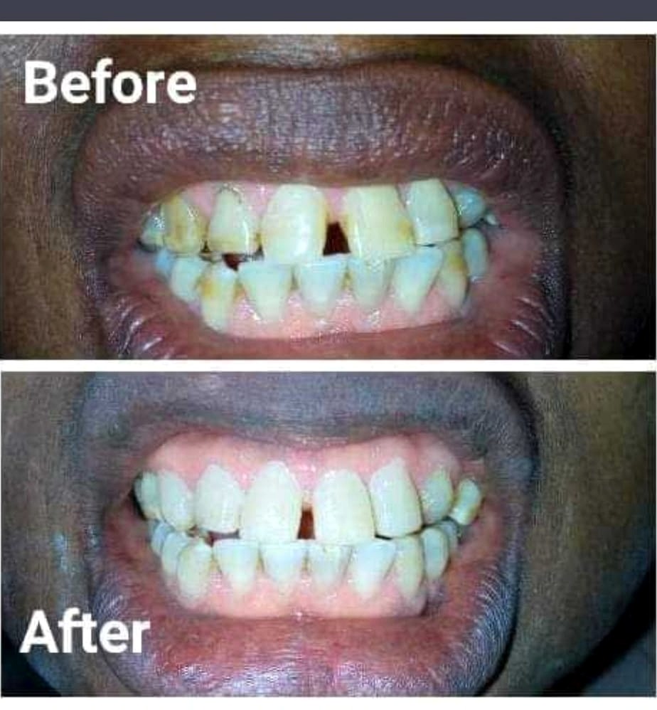 Teeth cleaning before and after