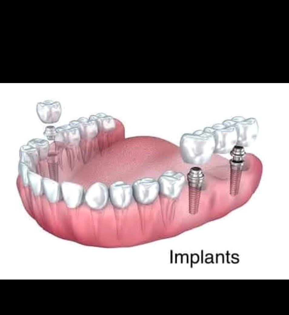 Illustration of dental implants