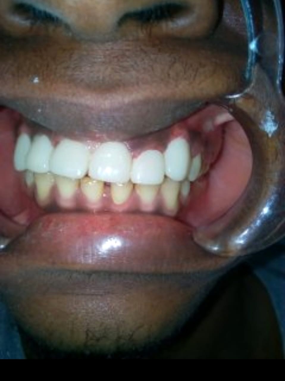 Dental restoration result