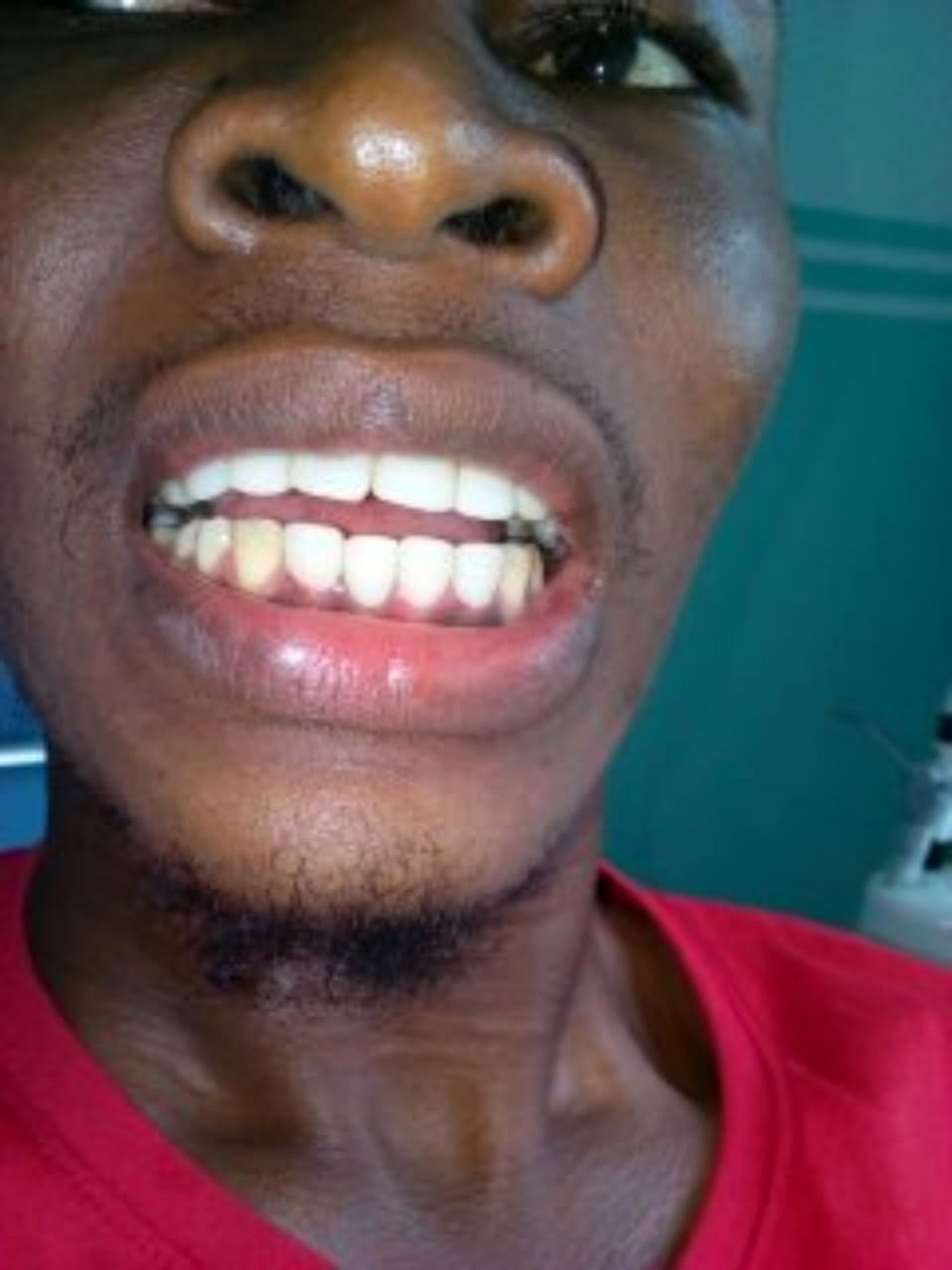 Smile result following dental treatment