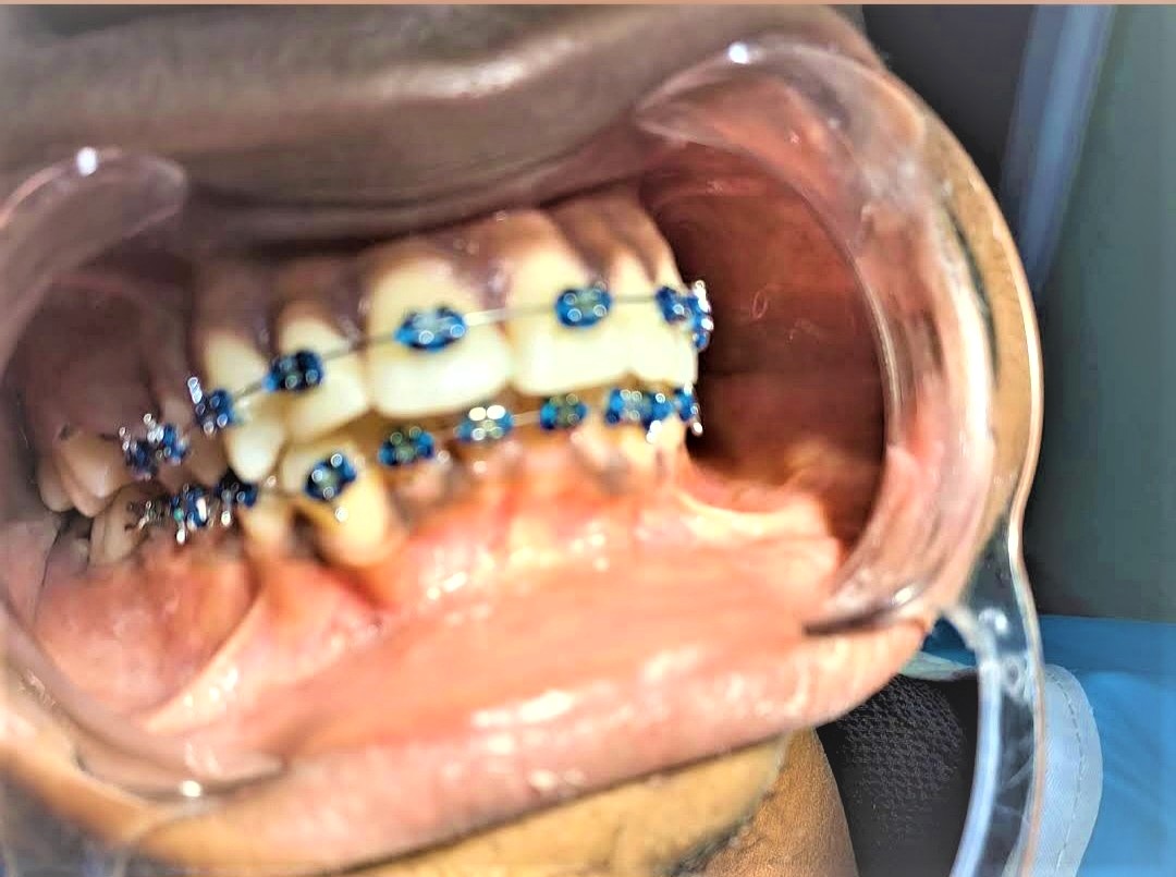 Braces treatment